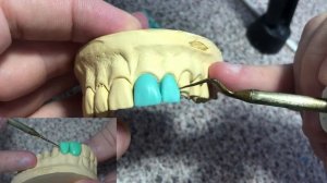 Моделировка зубов. Как моделировать боковой резец? Серия видео моделировки верхних зубов.