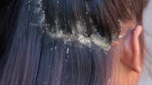 Breaking News!! Cute Girl Scratching Dandruff Big Worms On Head Scalp #