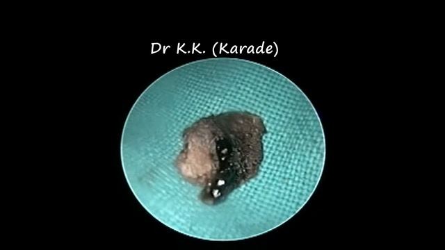 Dried Hemorrhagic Ear Canal Polyp Removal & Cleaning смотреть онлайн