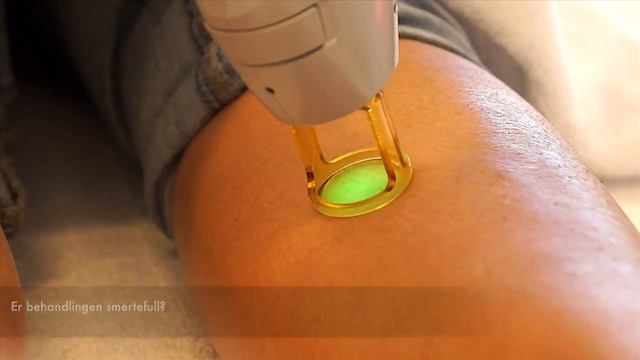 Hårfjerning med Candela Gentlemax Pro laser смотреть онлайн