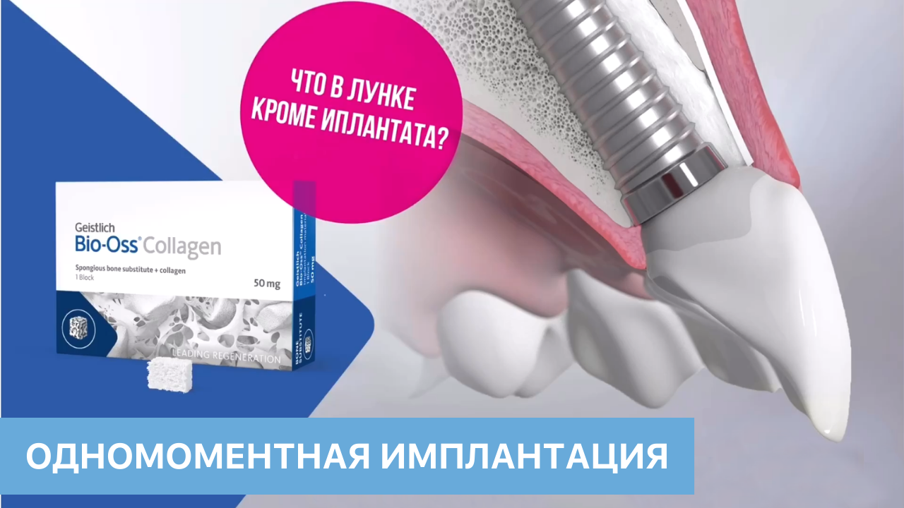 Одномоментная имплантация. Что в лунке кроме имплантата? Информационный фильм.