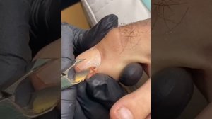 Пиогенная ГРАНУЛЕМА