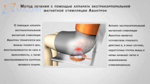 Авантрон - аппарат экстракорпоральной стимуляции органов малого таза