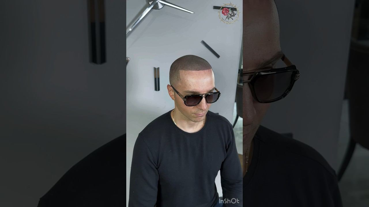 Так выглядит настоящее SMP! Трихопигментация после пересадки волос DHI Scalp micropigmentation