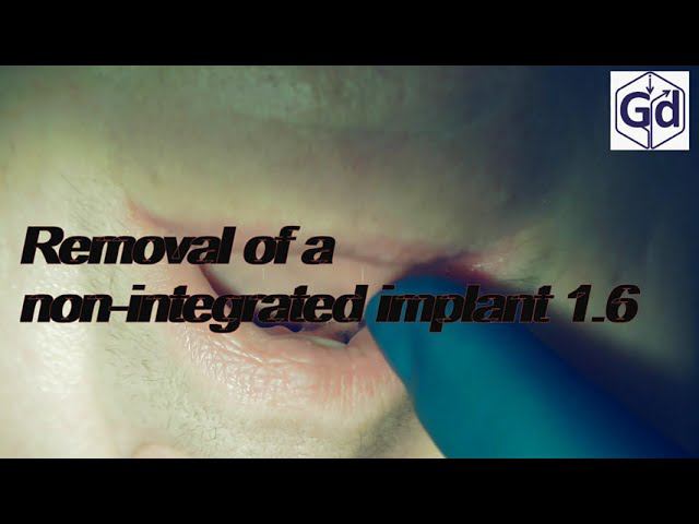 Removal of a non integrated implant 1. 6.