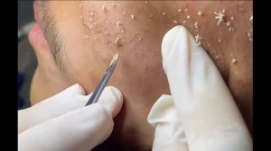 Удаление черных точек 2021 - Remoção de cravo 2021 - Pimple Popping 2021 -Blackhead Removal 2021