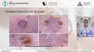 Неинвазивная диагностика немеланоцитарных новообразований кожи
