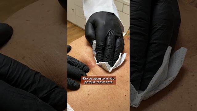 ⚠ [ IMPRESSIONANTE ] Veja como é a LIMPEZA de um CISTO SEBÁCEO na pele [ NÃO SE ASSUSTE ] смотреть онлайн