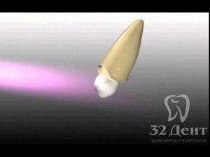 Эстетическая стоматология: восстановление зуба штифтом и коронкой
