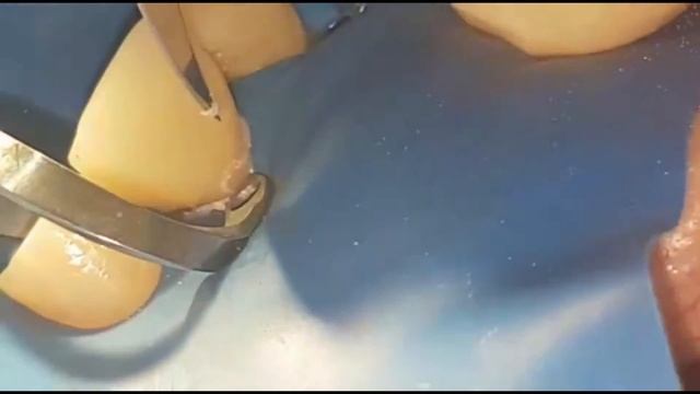 fixing the crown on the tooth , фиксация коронки на зуб , коронка emax , изоляция раббердам , зубы смотреть онлайн