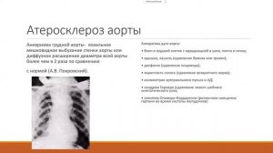 Атеросклероз  Лекция для студентов Проф  И В  Козлова