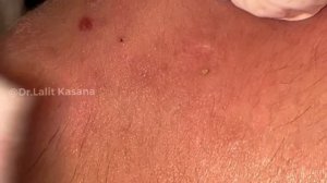 Super Satisfying Blackheads Removal video by Dr.Lalit Kasana