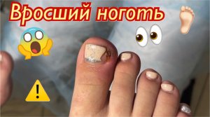 Вросший ноготь??⚠️ • Самопедикюр⛔️❌❗️