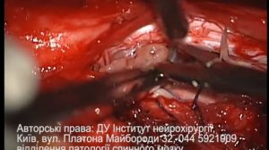 Лечение опухолей спинного мозга. Удаление опухолей спинного мозга.