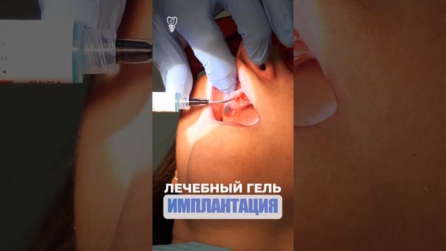 Лечебный гель. Therapeutic gel. Implantation.