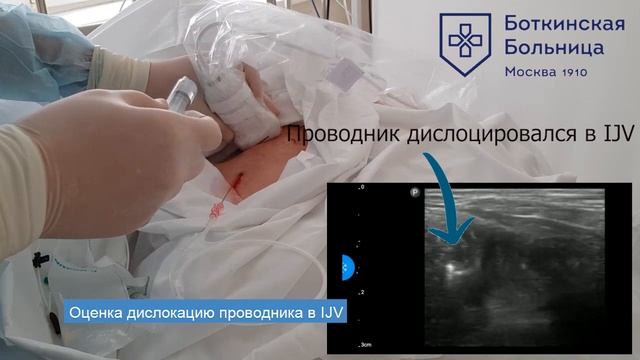 Ультразвуковая навигация катетеризации аксиллярной вены. In-Plane доступ.