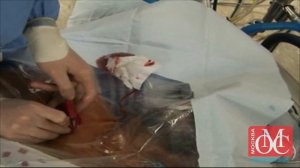 Катетеризации центральных вен   подключичной вены