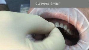 Пациенту вставили передний зуб (СЦ"Prime Smile")