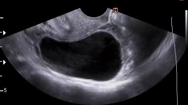 Кисты яичников(24-3-17) смотреть онлайн