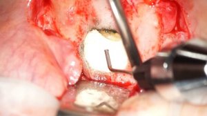 Резекция верхушки корня зуба