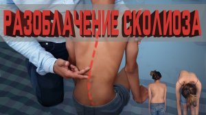 Что такое сколиоз?