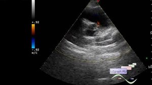 Детское УЗИ сердца (эхокардиография) - Коронарная фистула из левой коронарной артерии