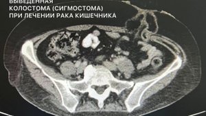 Выведенная колостома (сигмастома) при лечении рака прямой кишки (КТ до проведенной операции)