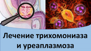 Лечение трихомониаза и уреаплазмоза