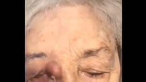 Гной из глаза