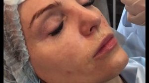 Коррекция щечно-скуловой зоны и аугментация губ филлером Helene All