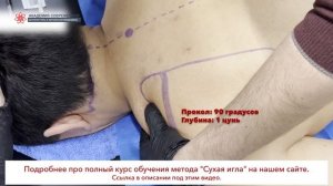 Сухая игла. TRAPEZIUS UPPER. ТРАПЕЦИЕВИДНАЯ МЫШЦА. Безопасная постановка иглы.