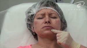 Коррекция залома на подбородке