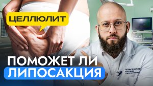 Поможет ли липосакция от целлюлита?