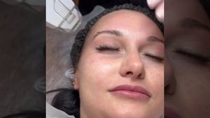 Микроигольчатый RF-лифтинг