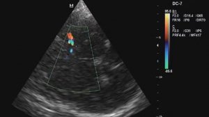 Транскраниальное сканирование - стеноз средней мозговой артерии менее 50%.