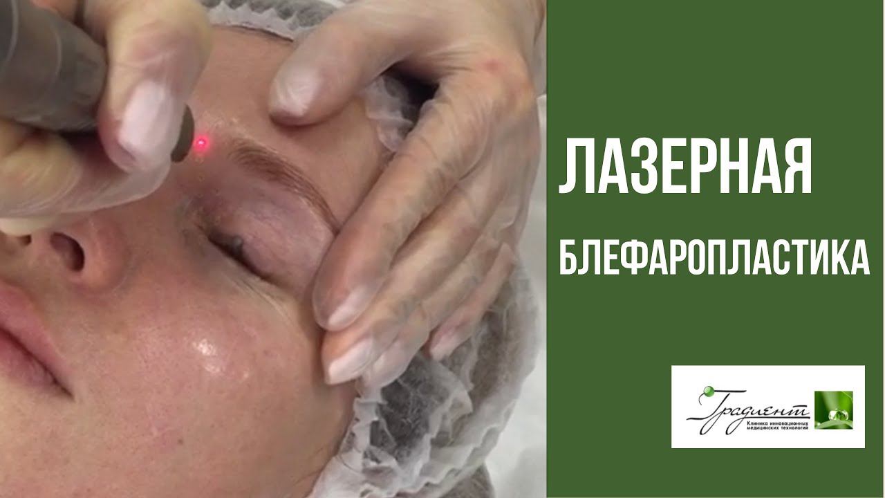 ЛАЗЕРНАЯ БЛЕФАРОПЛАСТИКА Fotona - проведение процедуры в клинике косметологии "Градиент"