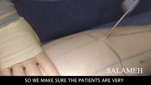 Lower Leg Lipedema HD Liposuction - Procedure (Pt. 2) | Salameh