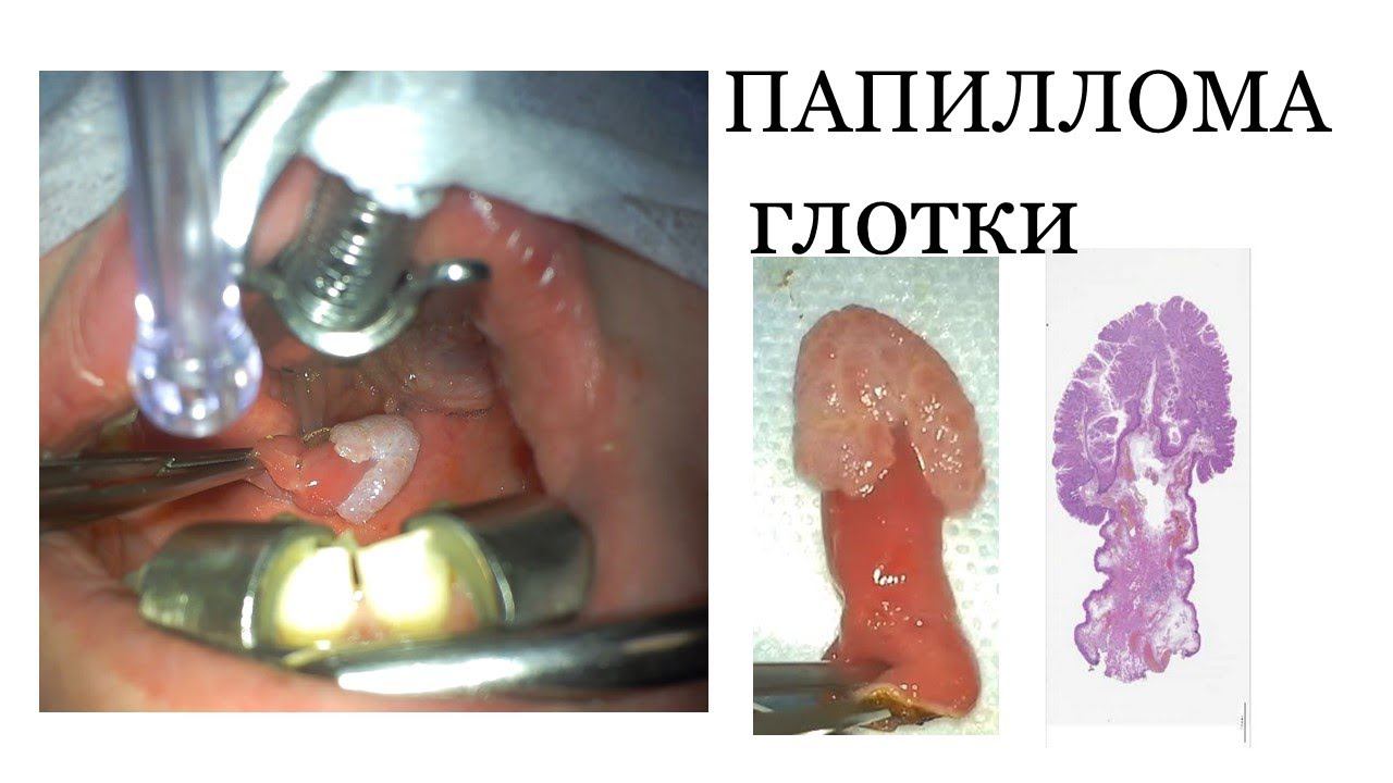 ПАПИЛЛОМА ГЛОТКИ / НОВООБРАЗОВАНИЕ ГЛОТКИ / УДАЛЕНИЕ НОВООБРАЗОВАНИЯ ГЛОТКИ смотреть онлайн