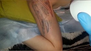 Лазерное удаление татуировок