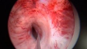 Рассечение стриктуры уретры.AVI