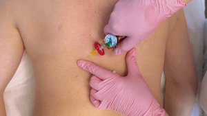 Процедура: инъекционная карбокситеропия