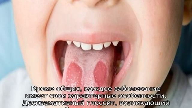 Почему у ребенка болит язык, поднимается температура — что делать смотреть онлайн