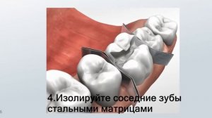 Препарирование под вкладку