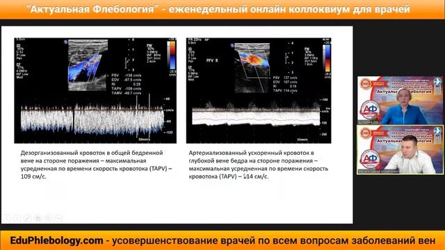 Дуплексное сканирование при врожденных сосудистых мальформациях смотреть онлайн