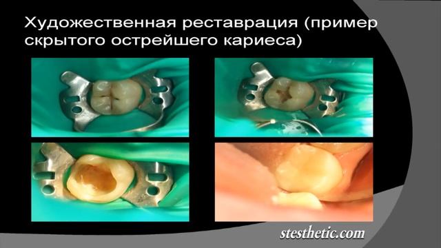 Художественные дентальные реставрации. estet-portal.com смотреть онлайн