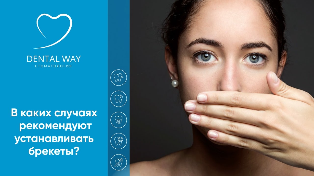 В каких случаях рекомендуют устанавливать брекеты