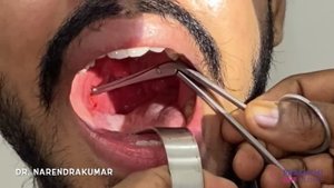 Removing Tonsillolith/ Stones in Tonsils- Dr. V. Narendrakumar