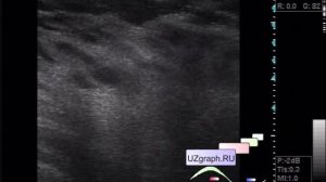УЗИ молочных желез - Образования молочных желез