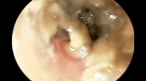 Грибковый отит и #фурункул #уха #гнойник лечение КЛИНИКА ОБРАЗЦОВА ЛОР врач