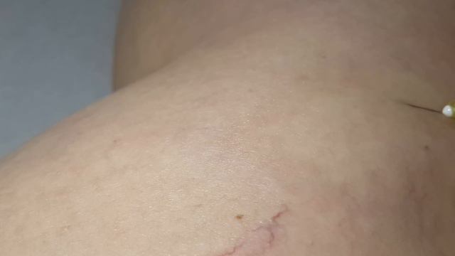 Sclerotherapy telangiectasia. Склеротерапия телангиэктазии.